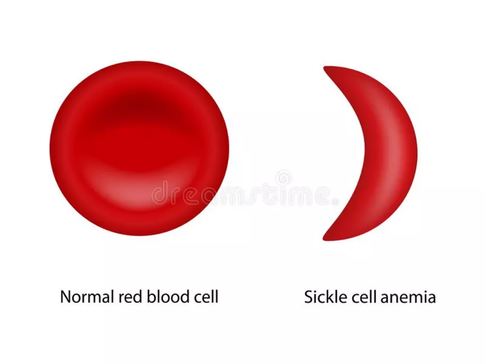 Sickle Cell Anemia and Sports Participation: Balancing Activity and Safety