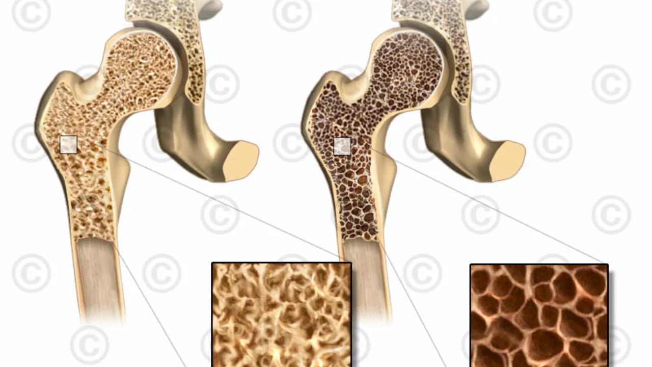 The Potential Role of Indapamide in Treating Osteoporosis